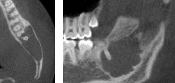 Case 1: Traumatic bone cyst that was successfully removed by oral surgeon