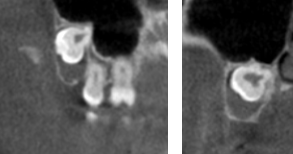Case 2: Dentigerous cyst around impacted wisdom tooth.  Referred to surgeon.
