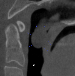 Case 3: Patient concern with breathing issues.  A large mass was discovered behind the soft palate.