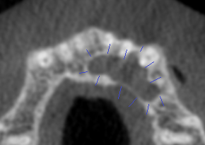 Case 4:   New patient exam uncovered a nasopalatine duct cyst behind the front top teeth going to the premolars.  Oral surgeon referral for removal.
