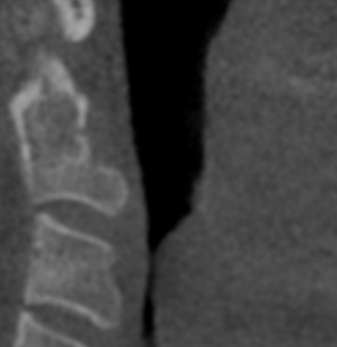 Case 6: Significant narrowing of lower airway noticed.  Biopsy identified cancer.  Surgery and treatment commenced.