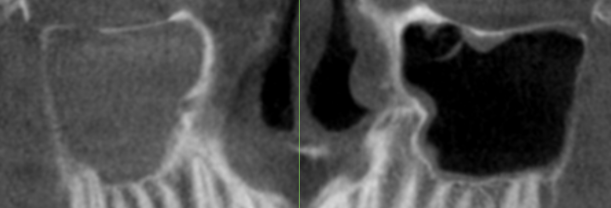 Case 7: It is common to see sinusitis.