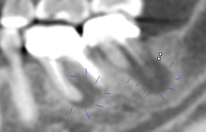 Case 8: CBCT is used weekly to evaluate root end abscess of dead, infected and broken teeth.

